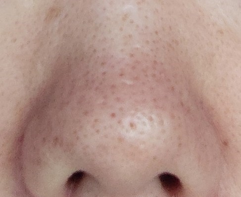 nose pores before using Demelan Cream