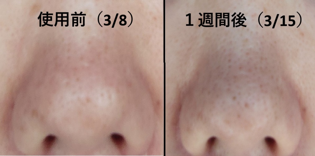 comparison of nose pores before and after using Demelan Cream