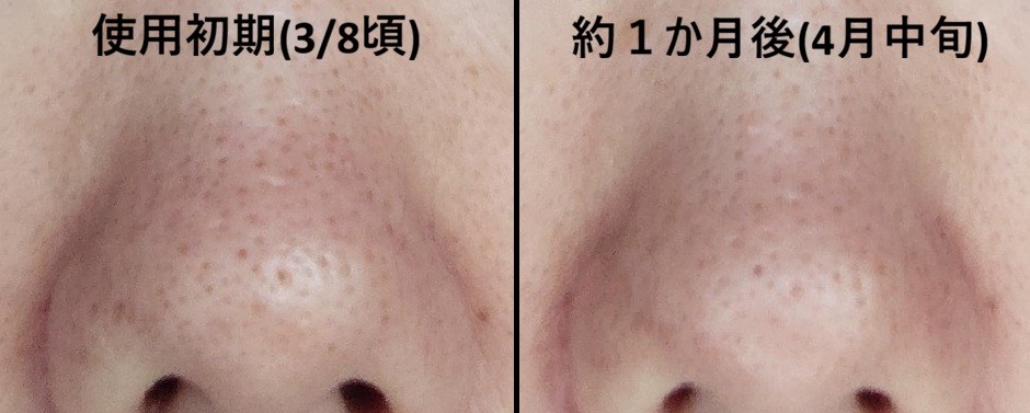 before-and-after comparison of strawberry nose pores after one month of using Demelan Cream