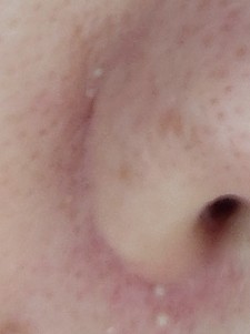 close-up of nose with whiteheads