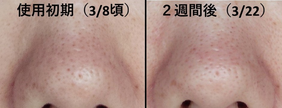 comparison of nose pores before and after using Demelan Cream