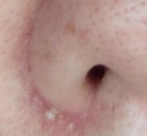 close-up of nose with whiteheads