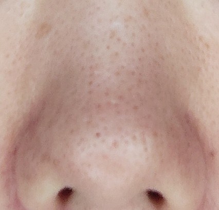 one-month results on strawberry nose pores

