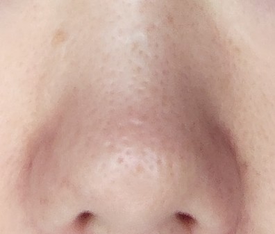 Close-up of nose skin after 2 months of using Demelan Cream
