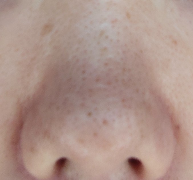 one-week progress on strawberry nose pores