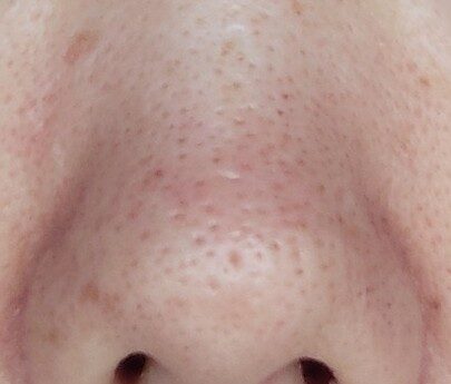 nose pores before using Demelan Cream